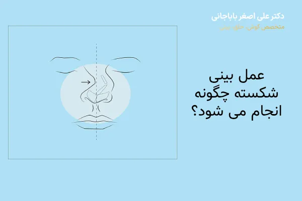 نحوه انجام عمل بینی شکسته