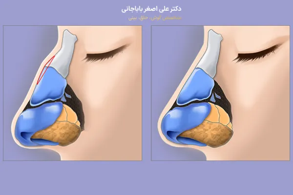 عمل قوز بینی