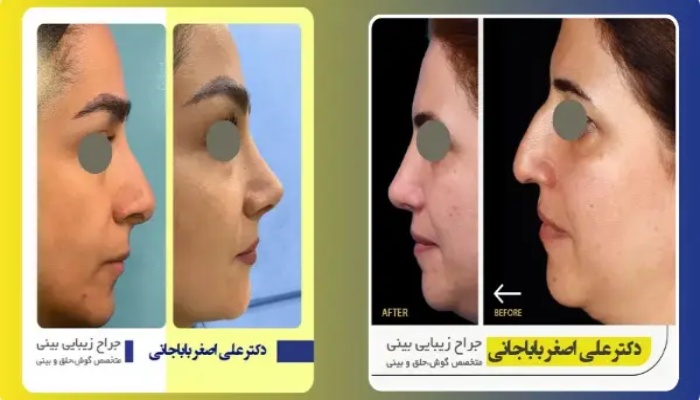 نمونه عمل بینی طبیعی