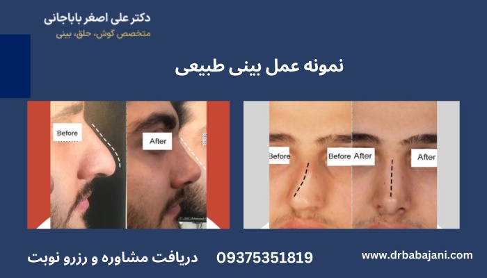 نمونه کار عمل بینی طبیعی