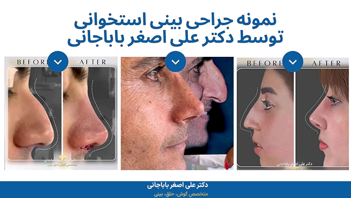 نمونه کار جراحی بینی استخوانی دکتر علی اصغر باباجانی