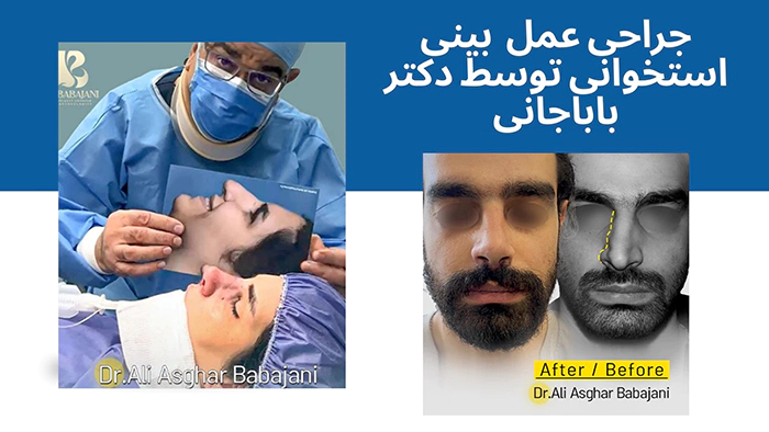 نمونه کار عمل بینی توسط بهترین جراح بینی استخوانی دکتر علی اصغر باباجانی