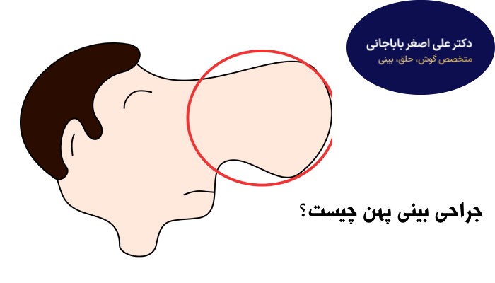 جراحی بینی چهن چیست؟