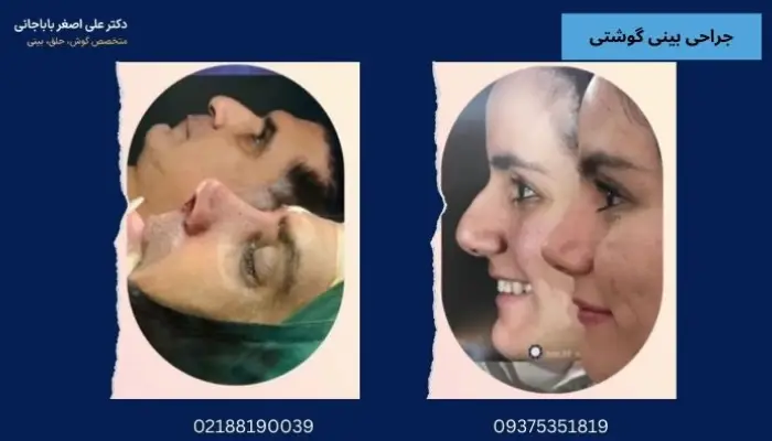 جراحی بینی گوشتی