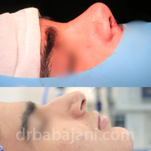 جراحی بینی طبیعی توسط بهترین جراح