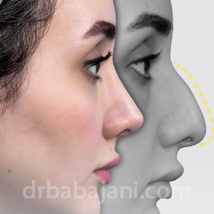 جراحی بینی طبیعی توسط بهترین دکتر