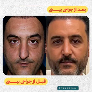 جراحی بینی طبیعی توسط دکتر باباجانی