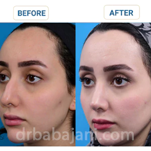 جراحی بینی طبیعی توسط دکتر علی اصغر باباجانی