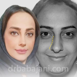 عمل بینی طبیعی توسط بهترین جراح بینی طبیعی