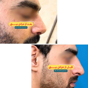عمل بینی طبیعی توسط دکتر باباجانی