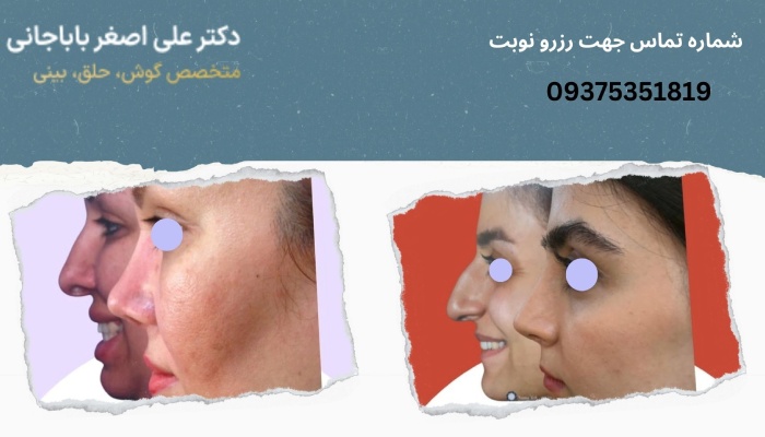نمونه کار بهترین جراح بینی طبیعی در تهران