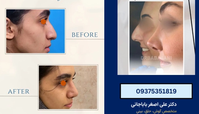 نمونه کار دکتر جراح بینی در جردن