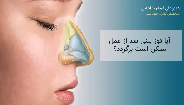 احتمال برگشت قوز بینی بعد از عمل