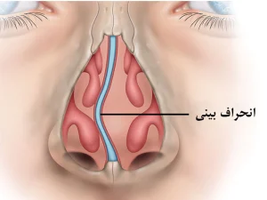 تصویر آناتومیک انحراف بینی و تیغه بینی