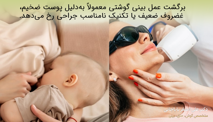 بازگشت بینی گوشتی بعد عمل