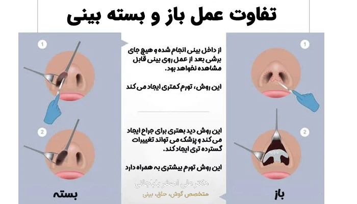 مقایسه عمل بینی باز و بسته