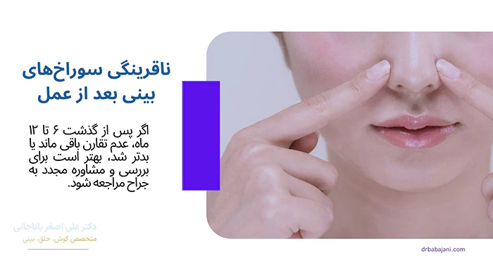 عدم تقارن سوراخ بینی بعد از عمل