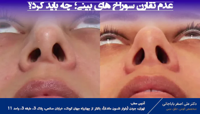 عدم تقارن سوراخ های بینی