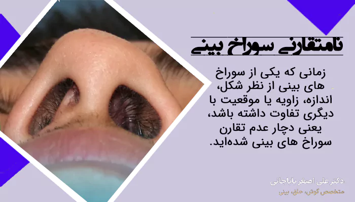 نامتقارنی سوراخ بینی