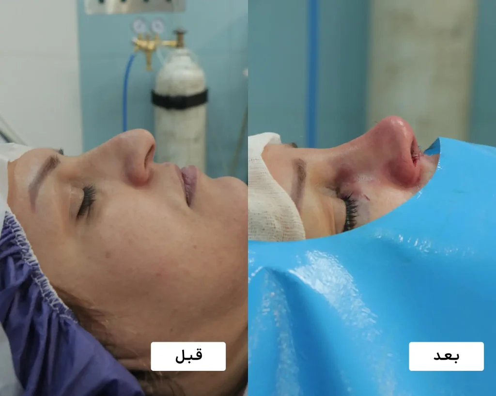 نمونه واقعی جراحی بینی توسط دکتر باباجانی
