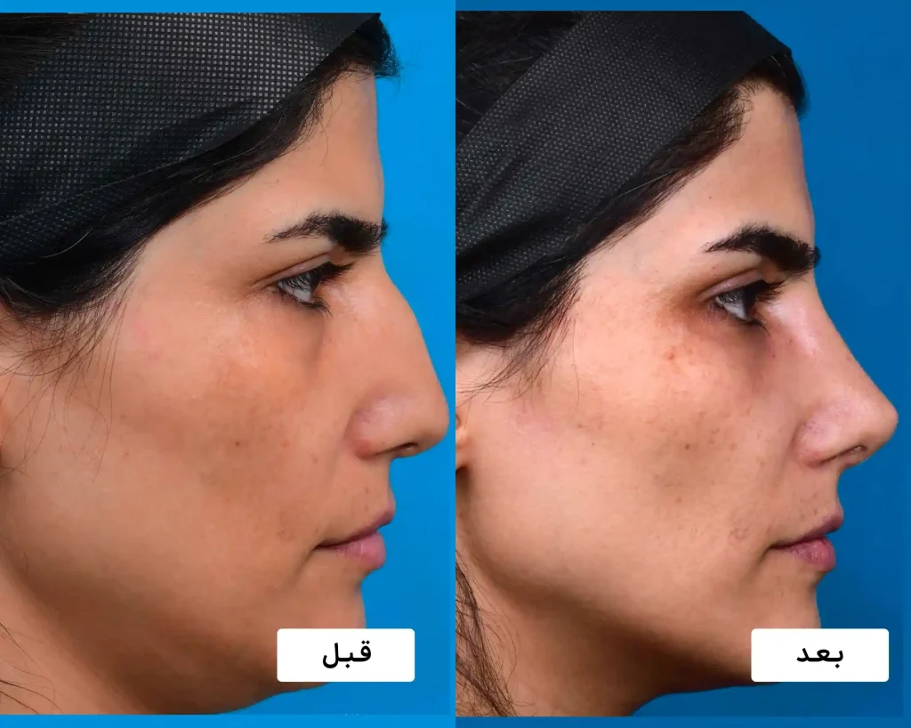 فرم بینی بعد از عمل توسط دکتر باباجانی