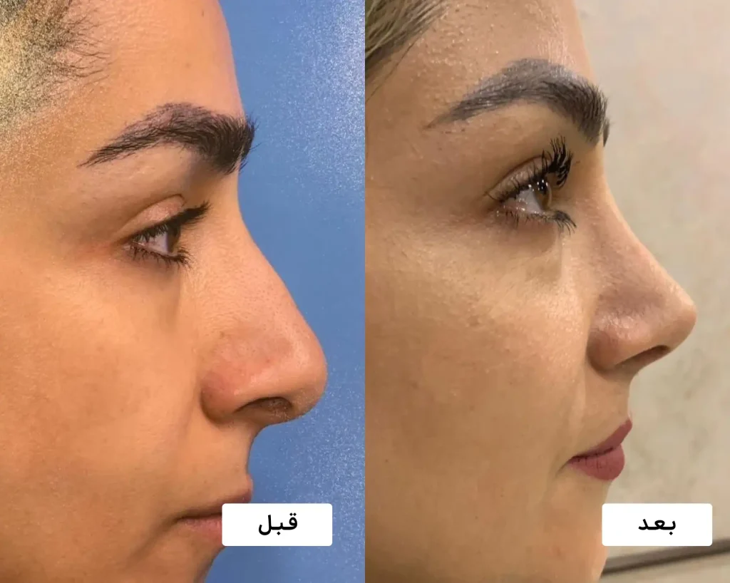 نمونه کار عمل بینی توسط بهترین جراح بینی دکتر باباجانی