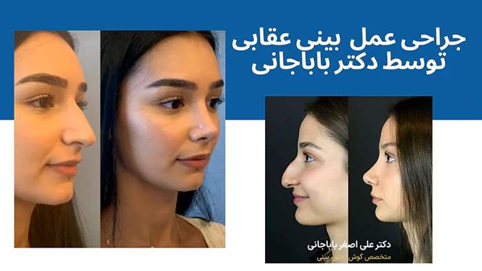 جراحی عمل بینی عقابی توسط دکتر باباجانی