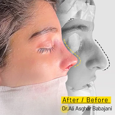 جراحی بینی گوشتی توسط دکتر باباجانی