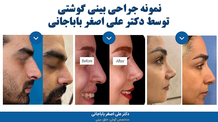 نمونه جراحی بینی گوشتی توسط دکتر علی اصغر باباجانی