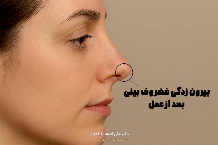 عکس بیرون زدگی غضزوف بینی