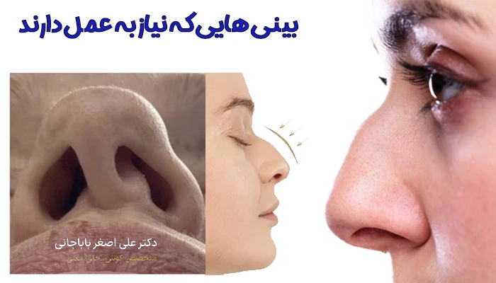 بینی هایی که نیاز به عمل دارند