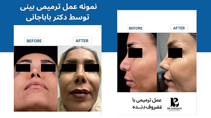 نمونه عمل ترمیمی بینی